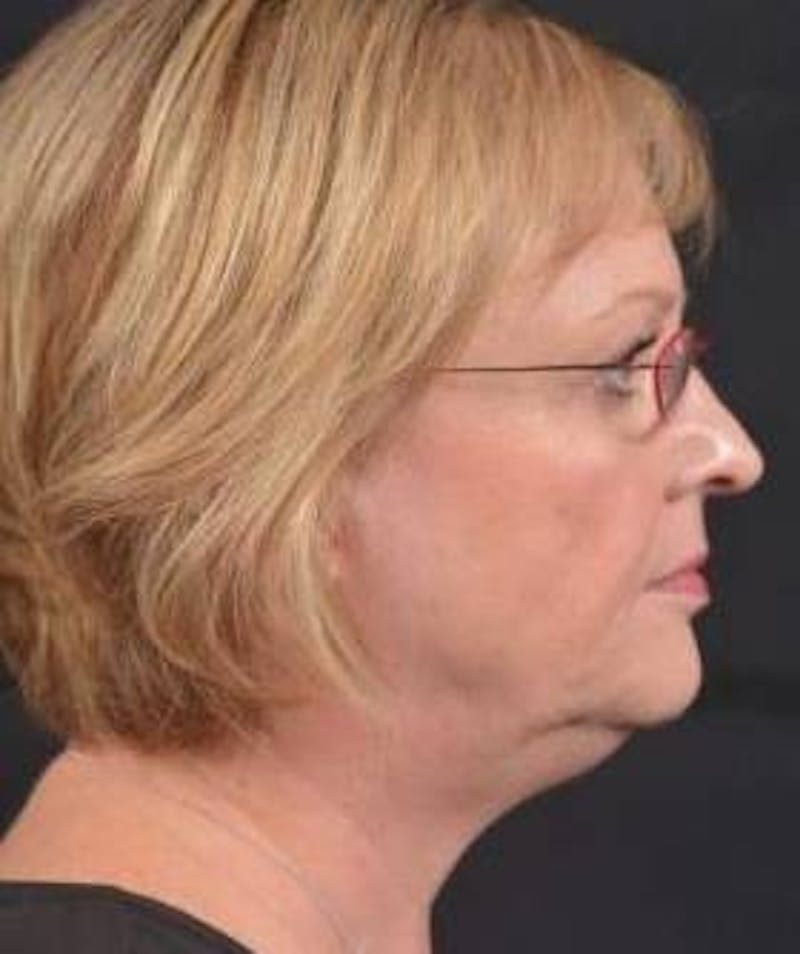 FaceTite Before & After Gallery - Patient 254194 - Image 5