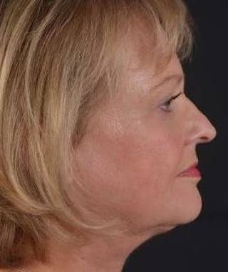 FaceTite Before & After Gallery - Patient 254194 - Image 6