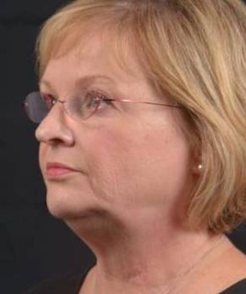 FaceTite Before & After Gallery - Patient 254194 - Image 7