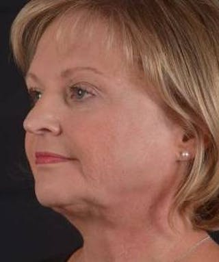 FaceTite Before & After Gallery - Patient 254194 - Image 8