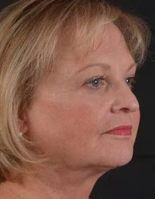 FaceTite Before & After Gallery - Patient 254194 - Image 10