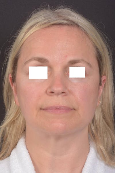 FaceTite Before & After Gallery - Patient 225509 - Image 1