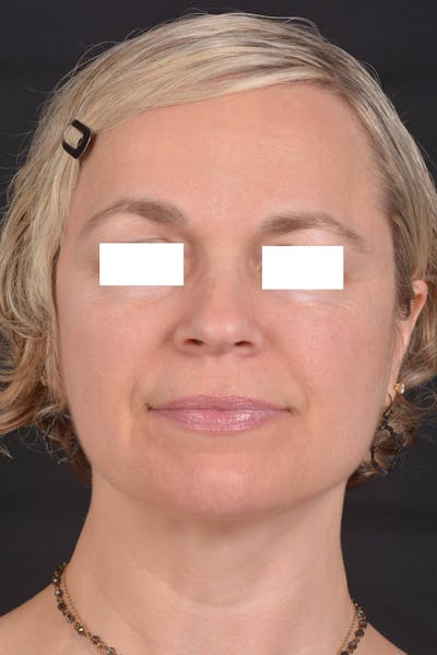 FaceTite Before & After Gallery - Patient 225509 - Image 2