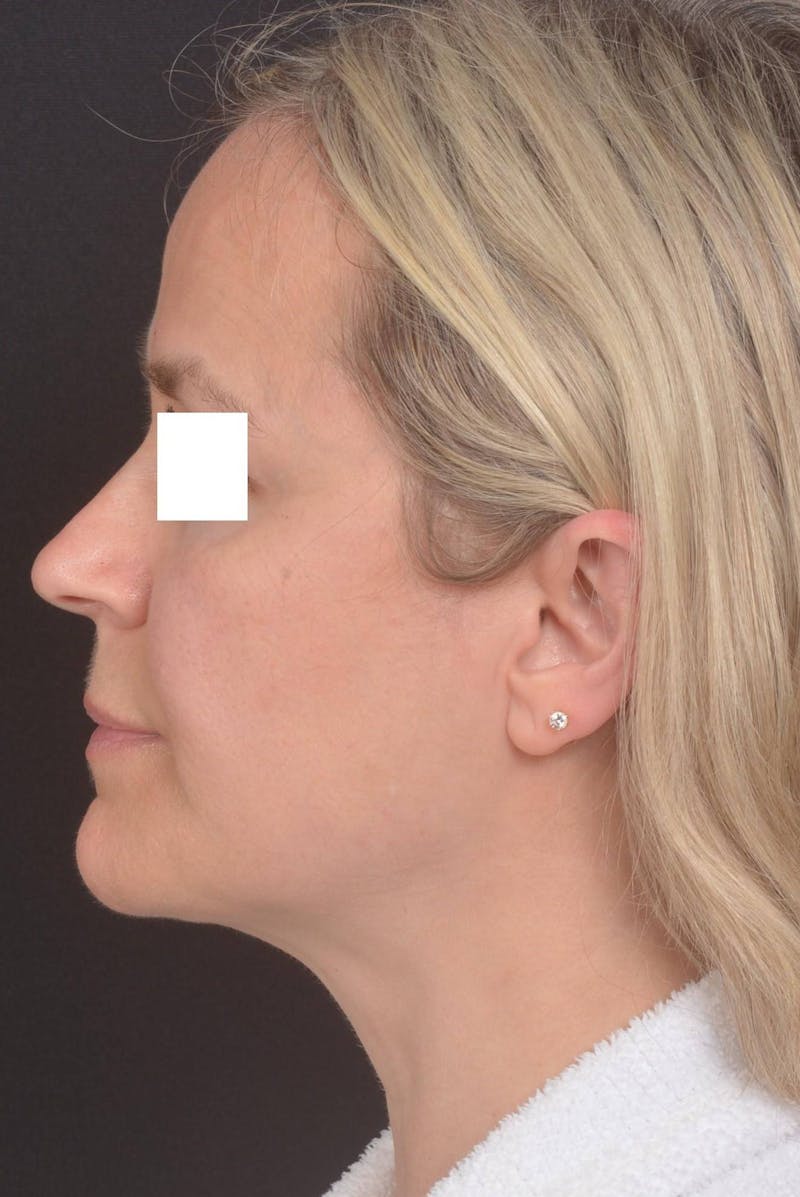 FaceTite Before & After Gallery - Patient 225509 - Image 3