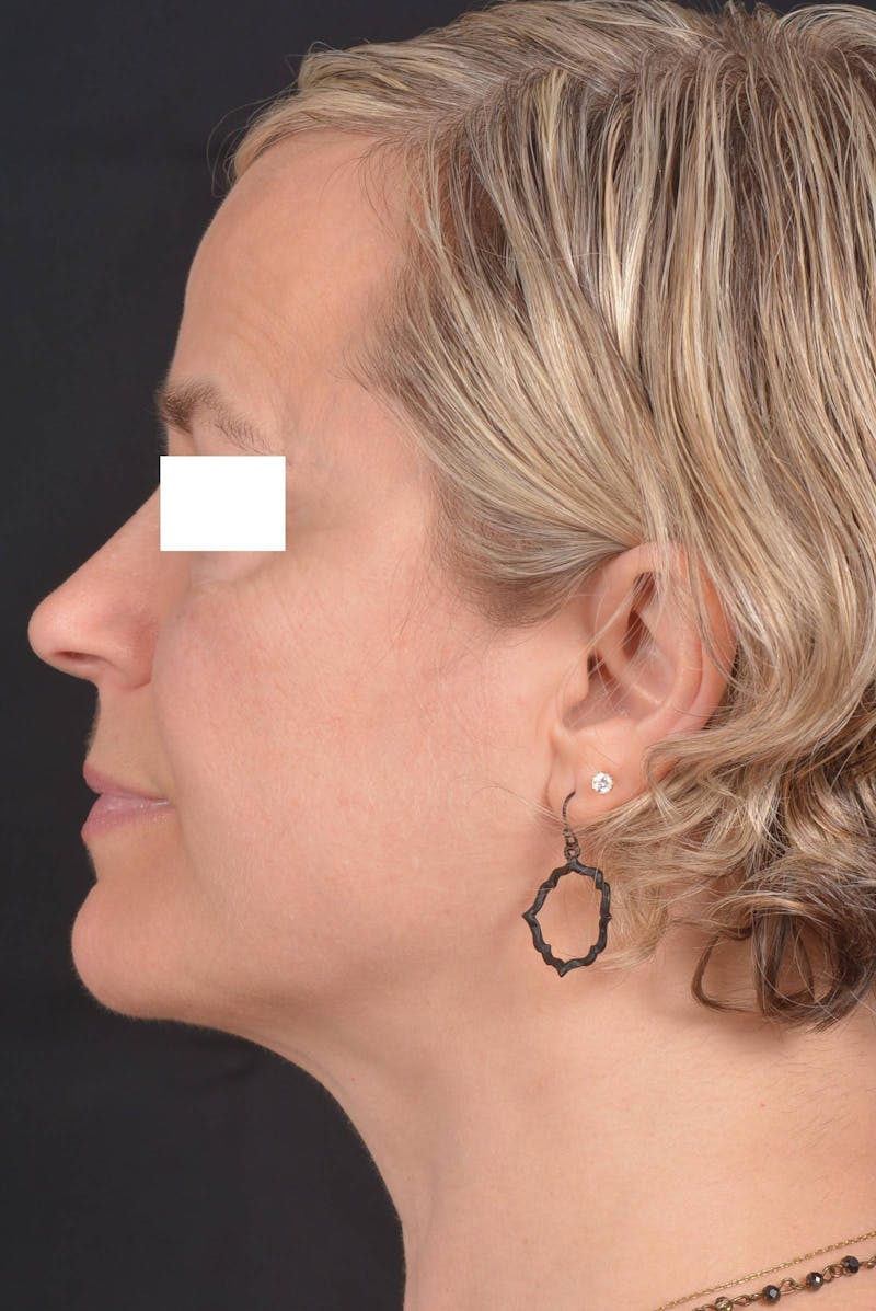FaceTite Before & After Gallery - Patient 225509 - Image 4