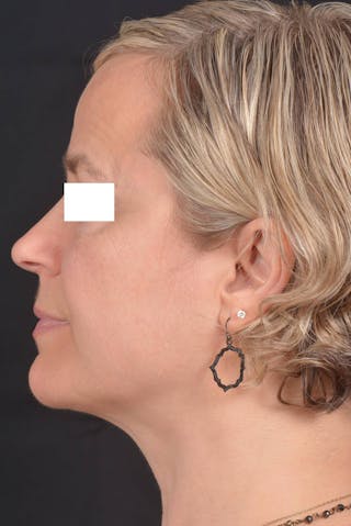 FaceTite Before & After Gallery - Patient 225509 - Image 4