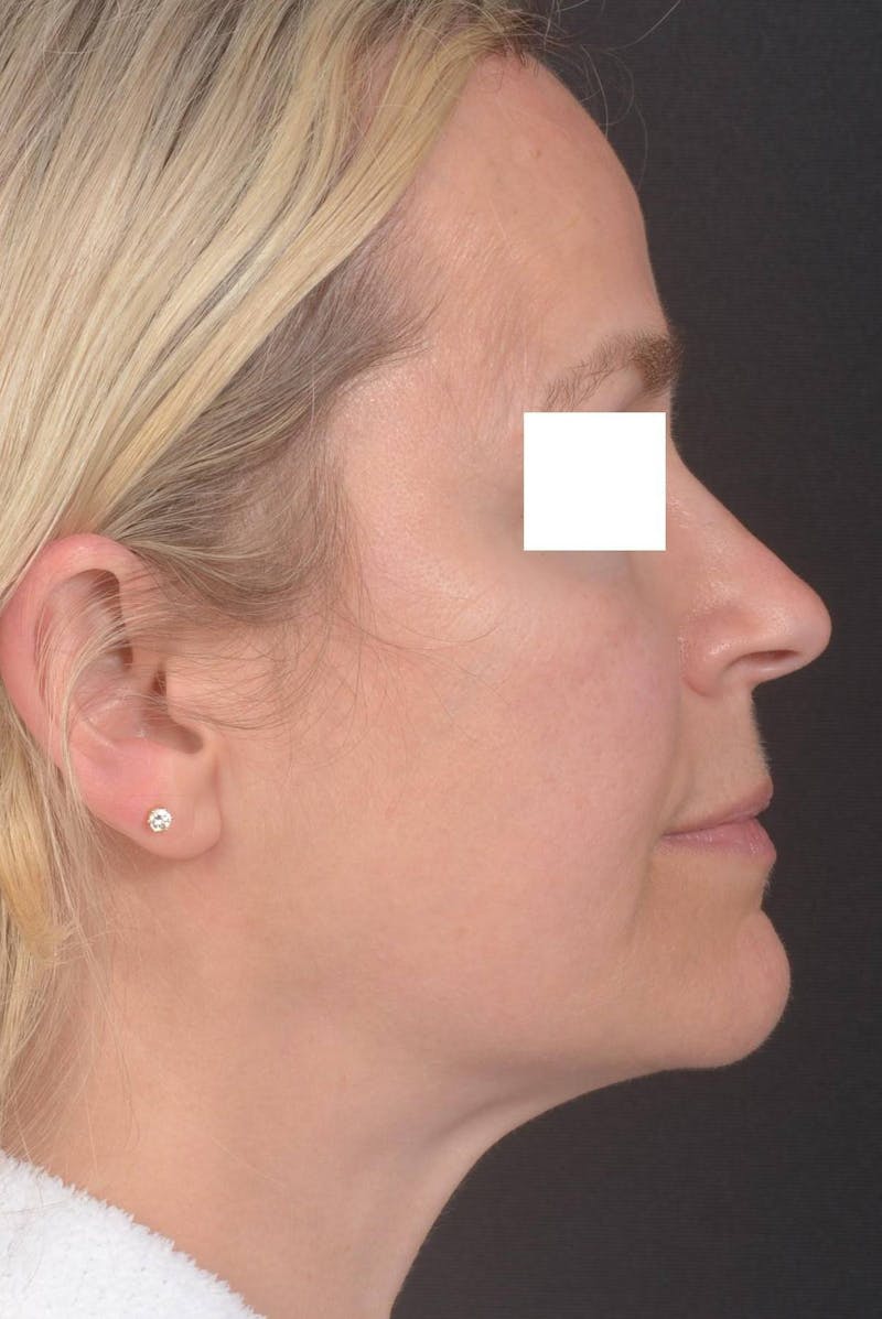 FaceTite Before & After Gallery - Patient 225509 - Image 5