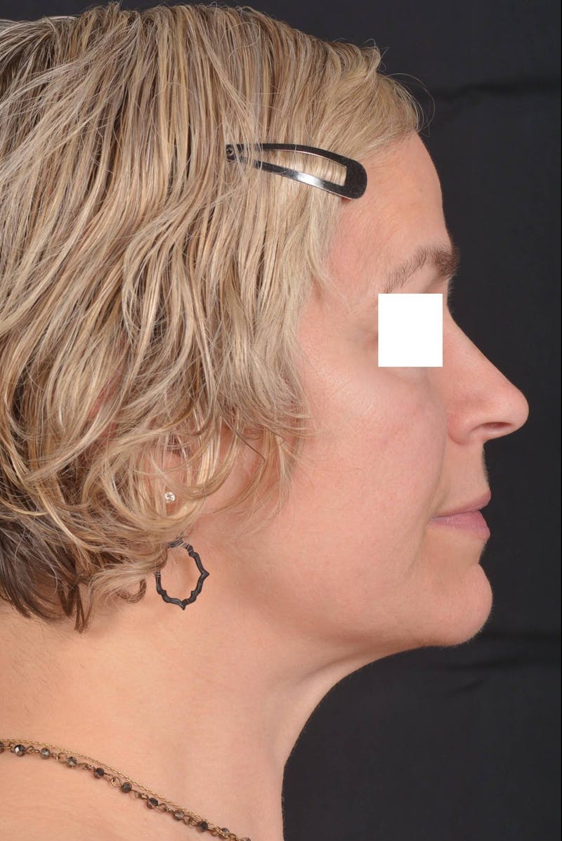FaceTite Before & After Gallery - Patient 225509 - Image 6