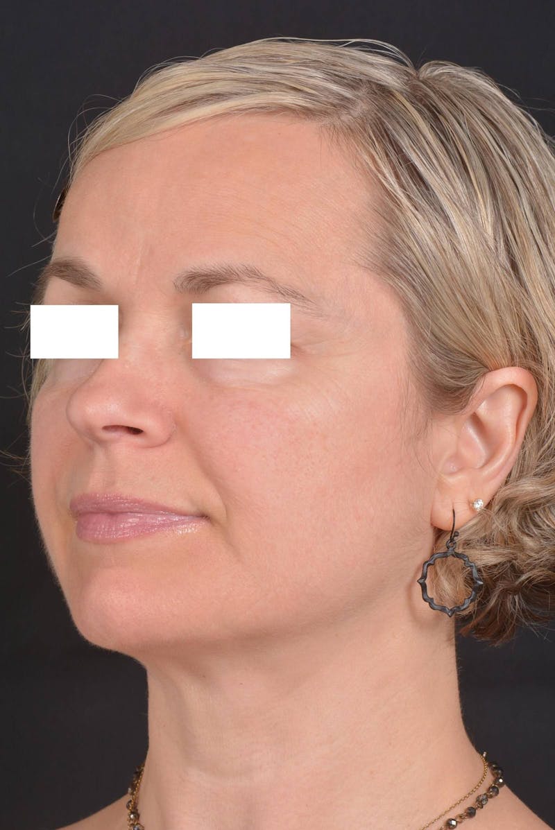 FaceTite Before & After Gallery - Patient 225509 - Image 8