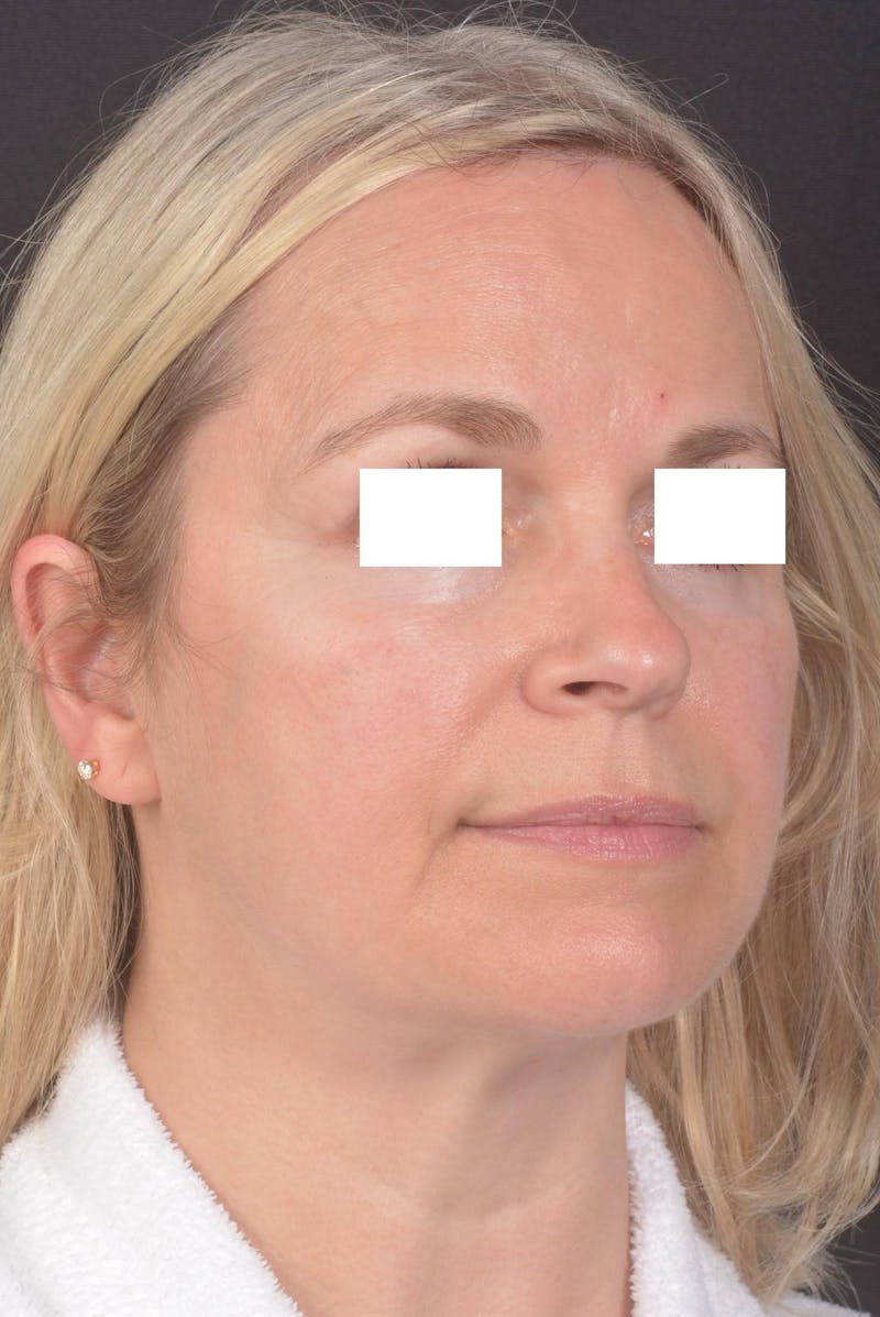 FaceTite Before & After Gallery - Patient 225509 - Image 9