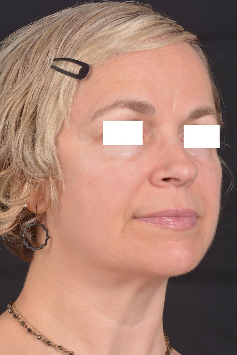 FaceTite Before & After Gallery - Patient 225509 - Image 10