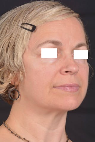 FaceTite Before & After Gallery - Patient 225509 - Image 10