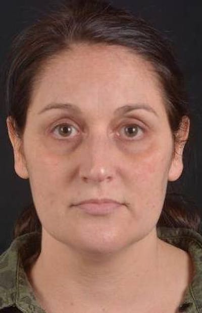 FaceTite Before & After Gallery - Patient 184387 - Image 1