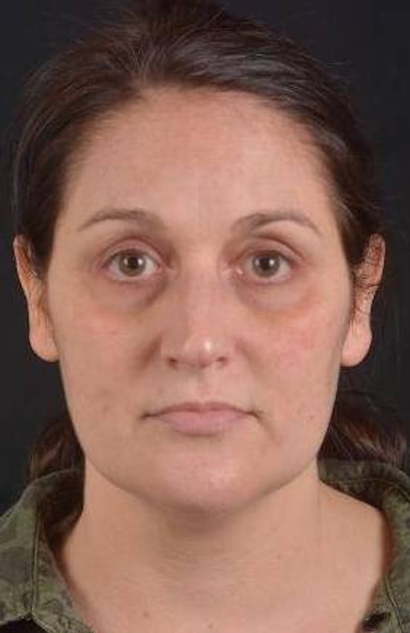 FaceTite Before & After Gallery - Patient 184387 - Image 1
