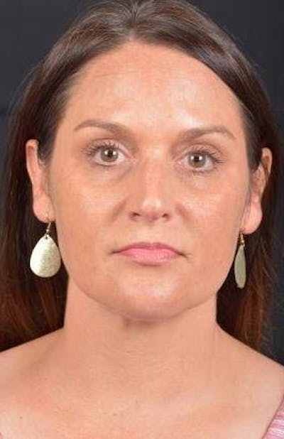 FaceTite Before & After Gallery - Patient 184387 - Image 2