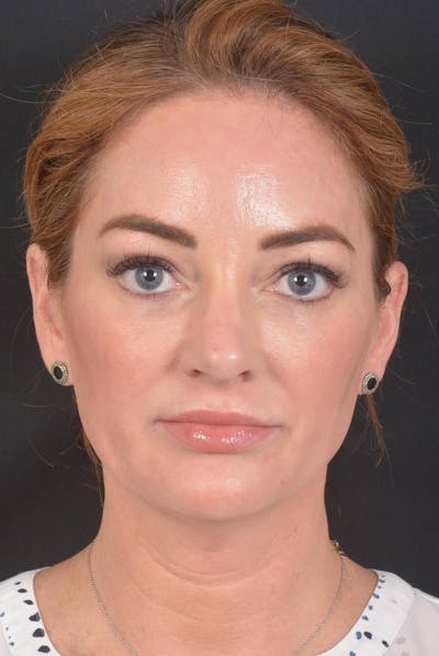 Necklift Before & After Gallery - Patient 158242 - Image 1