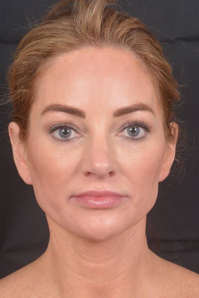 Necklift Before & After Gallery - Patient 158242 - Image 2