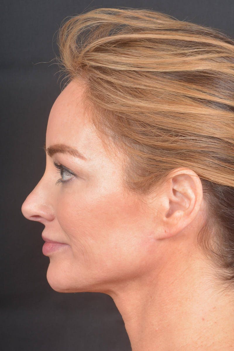 Necklift Before & After Gallery - Patient 158242 - Image 4