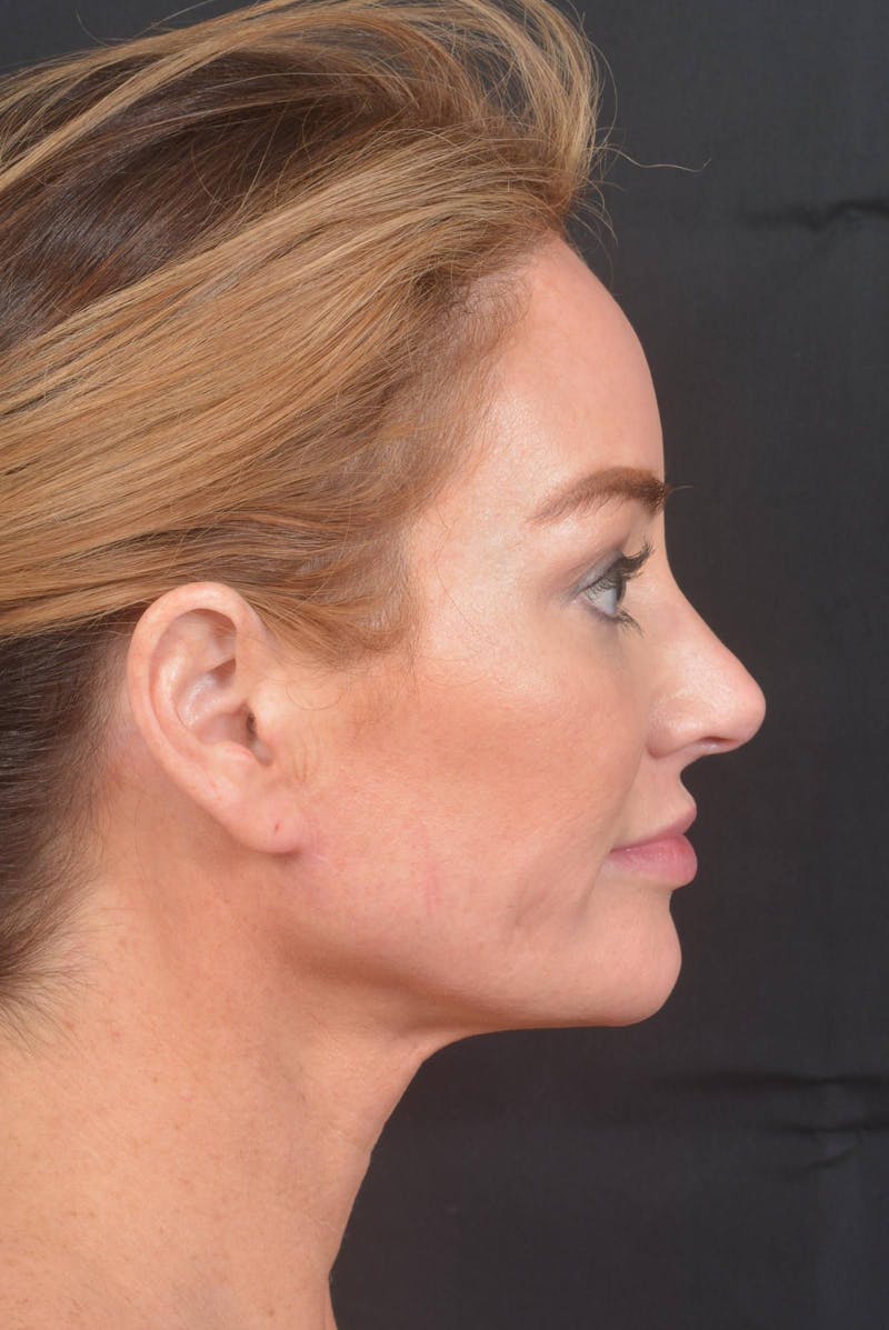 Necklift Before & After Gallery - Patient 158242 - Image 6