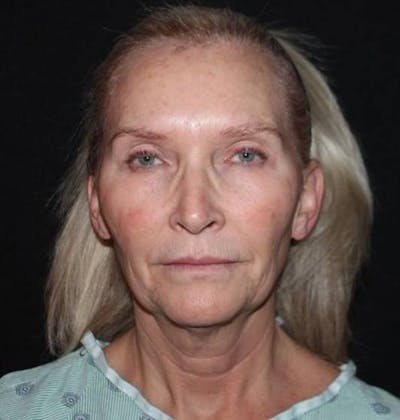 Necklift Before & After Gallery - Patient 103185 - Image 1