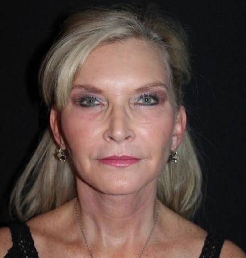 Necklift Before & After Gallery - Patient 103185 - Image 2