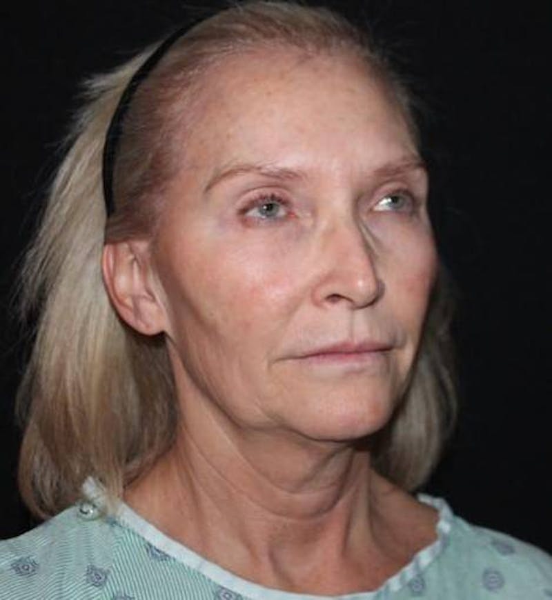 Necklift Before & After Gallery - Patient 103185 - Image 7
