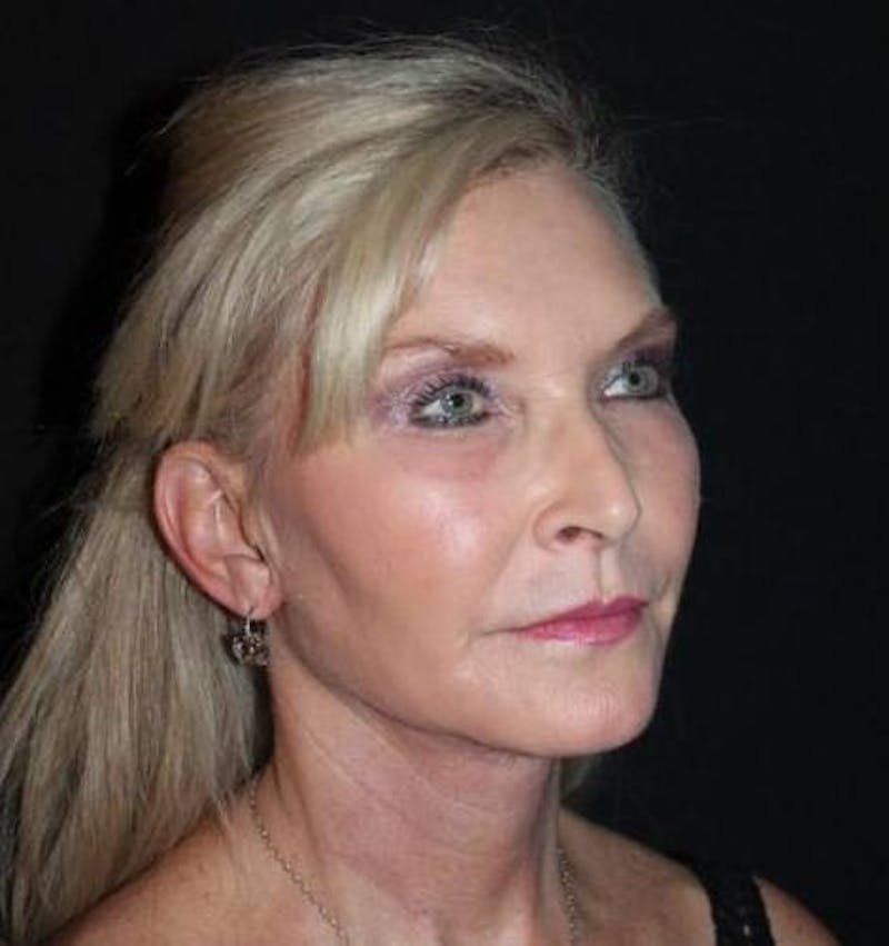 Necklift Before & After Gallery - Patient 103185 - Image 8
