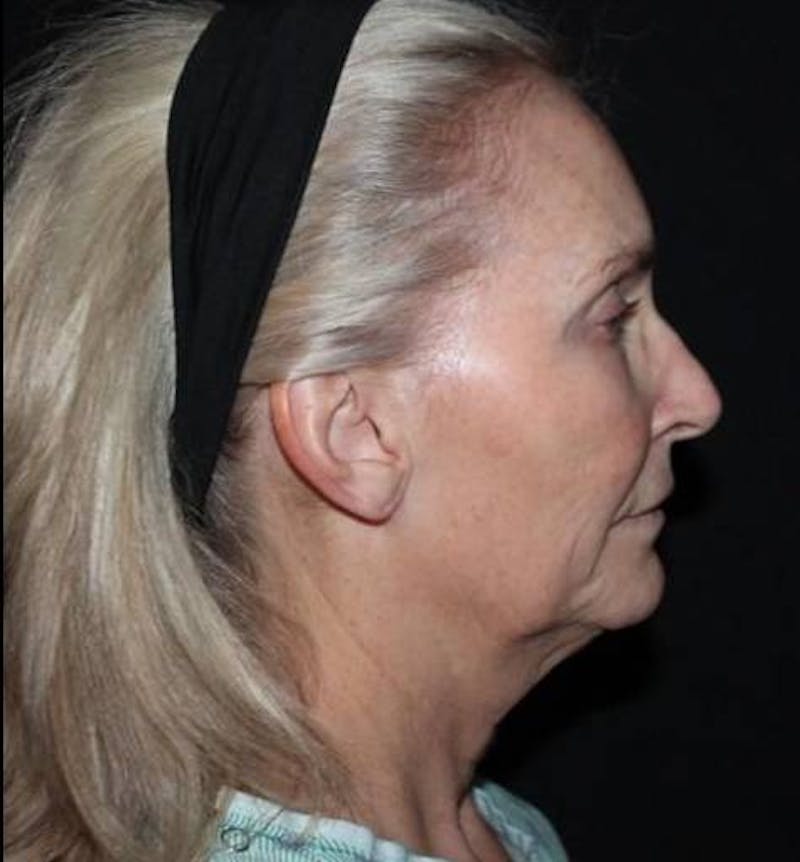 Necklift Before & After Gallery - Patient 103185 - Image 9