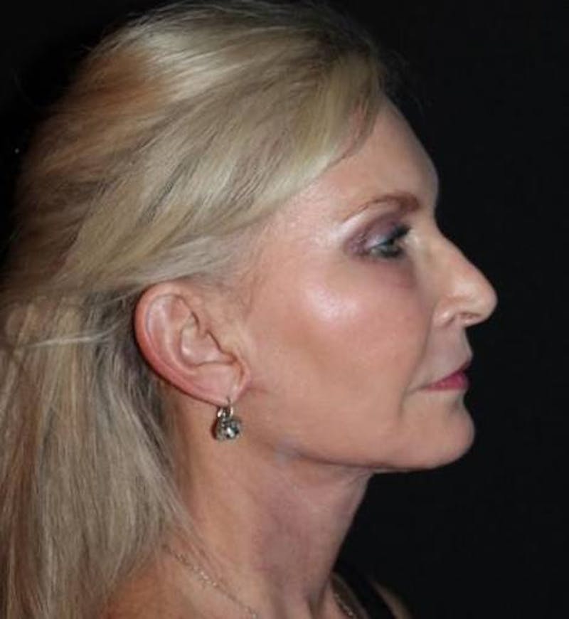 Necklift Before & After Gallery - Patient 103185 - Image 10