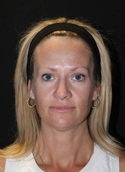 Necklift Before & After Gallery - Patient 556205 - Image 1