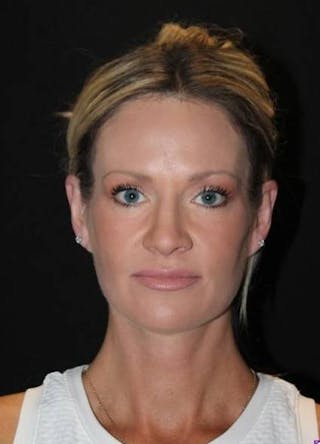 Necklift Before & After Gallery - Patient 556205 - Image 2