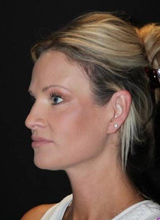 Necklift Before & After Gallery - Patient 556205 - Image 4