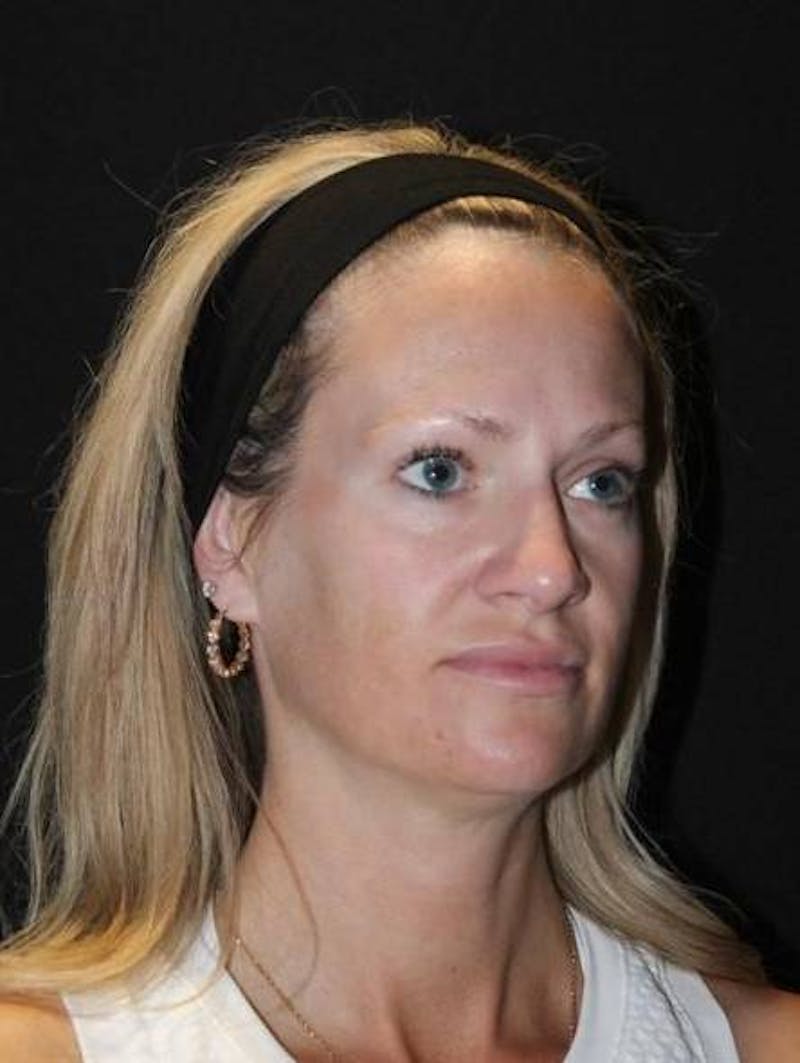 Necklift Before & After Gallery - Patient 556205 - Image 7