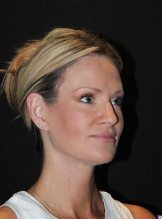 Necklift Before & After Gallery - Patient 556205 - Image 8