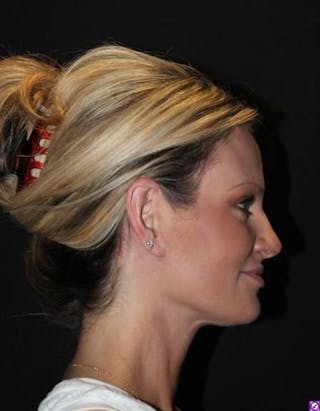 Necklift Before & After Gallery - Patient 556205 - Image 10