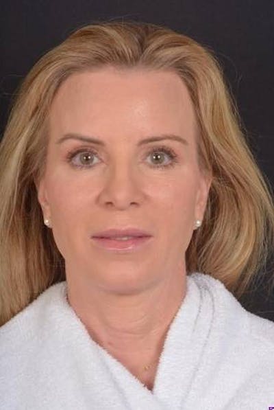 Necklift Before & After Gallery - Patient 938209 - Image 1