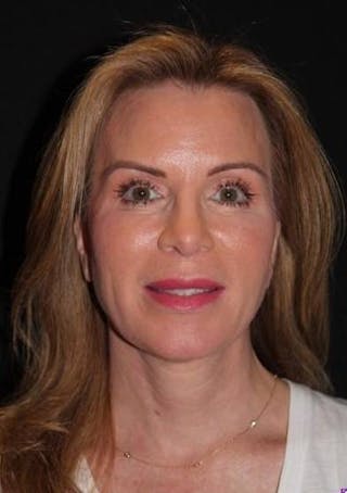 Necklift Before & After Gallery - Patient 938209 - Image 2