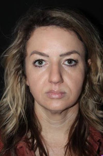 Rhinoplasty Before & After Gallery - Patient 428770 - Image 1