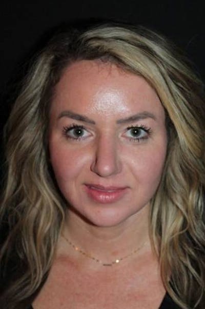 Rhinoplasty Before & After Gallery - Patient 428770 - Image 2