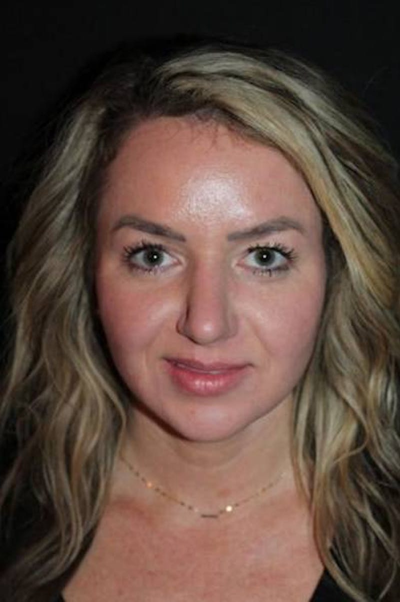 Rhinoplasty Before & After Gallery - Patient 428770 - Image 2