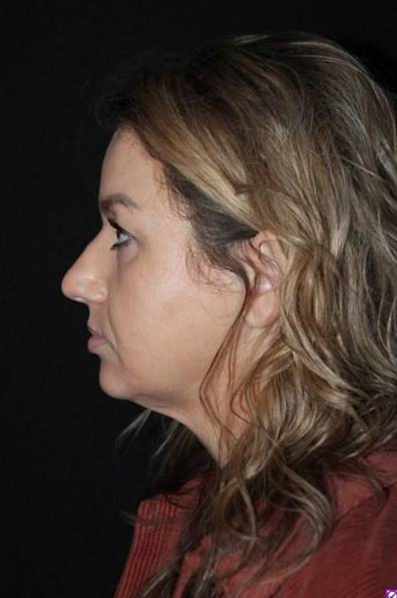 Necklift Before & After Gallery - Patient 534647 - Image 5