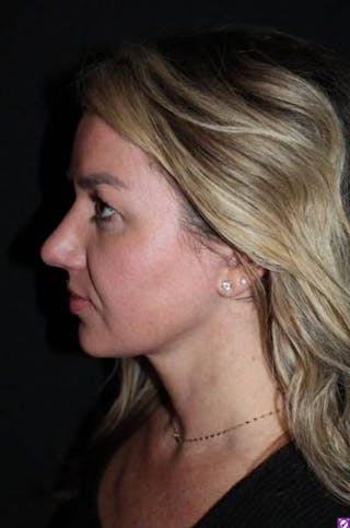 Necklift Before & After Gallery - Patient 534647 - Image 6