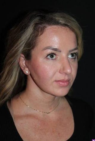 Necklift Before & After Gallery - Patient 534647 - Image 8