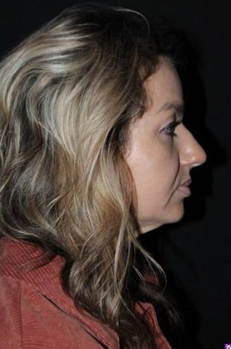 Necklift Before & After Gallery - Patient 534647 - Image 9