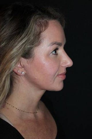 Necklift Before & After Gallery - Patient 534647 - Image 10