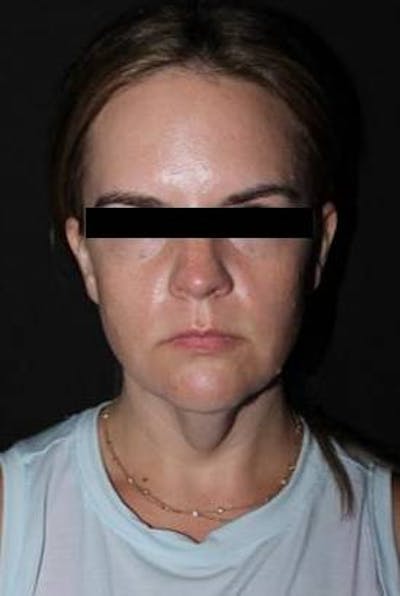 Necklift Before & After Gallery - Patient 309823 - Image 1