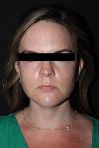 Necklift Before & After Gallery - Patient 309823 - Image 2