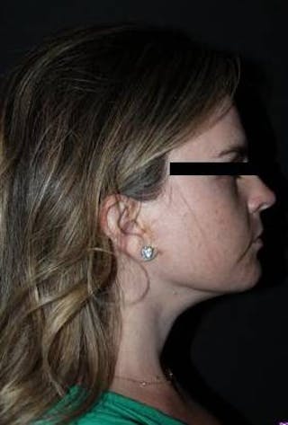 Necklift Before & After Gallery - Patient 309823 - Image 10