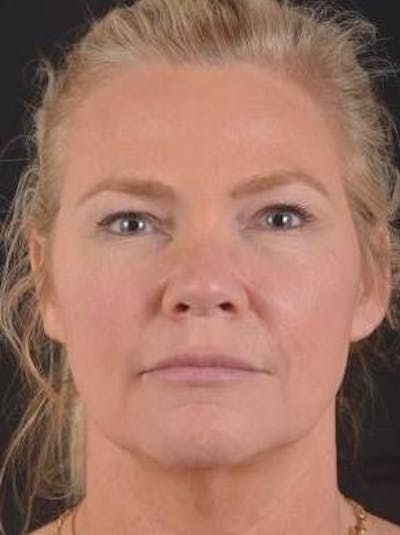 Necklift Before & After Gallery - Patient 416332 - Image 1