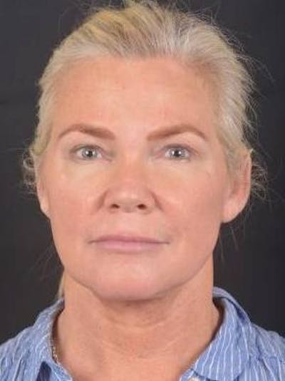 Necklift Before & After Gallery - Patient 416332 - Image 2